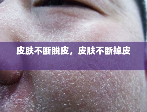 皮肤不断脱皮,皮肤不断掉皮